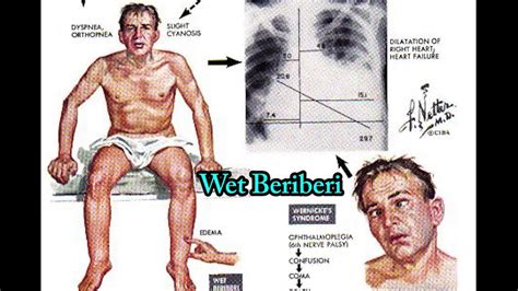 beriberi pictures